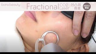 凹凸洞治療 你需要Fractional CO2 Laser!  Bora beauty