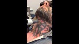 Laser Tattoo Removal Session on Neck