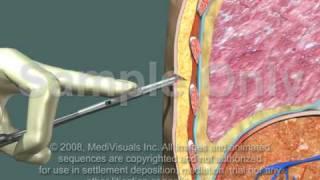 Thoracotomy - Normal Procedure