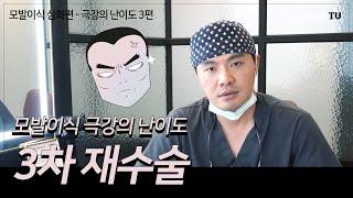 모발이식 3차 재수술 | 모발이식 극강의 난이도 3편