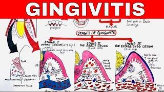 Gingivitis - Stages of Gingival Inflammation