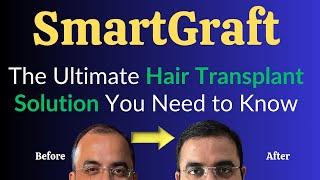 SmartGraft: The Ultimate Hair Transplant Solution You Need to Know