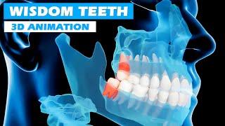 Wisdom Teeth Extraction | 3D Animation