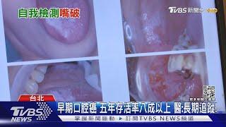 輕忽「嘴破」這幾種症狀...醫:罹「口腔癌」機率增 速就醫!｜十點不一樣20221115