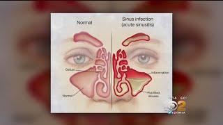 Doctor: Tried And True Methods For Sinus Relief Are Still Best