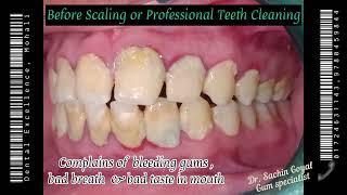 Scaling / Professional Cleaning / Oral Prophylaxsis