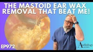 THE MASTOID EAR WAX REMOVAL THAT BEAT ME! - EP972