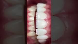 Composite restoration #dentist  #dentistry #dentalcare #shorts