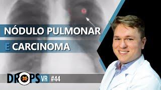 NÓDULO PULMONAR E CARCINOMA