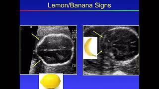 Fetal Congenital anomalies part 1