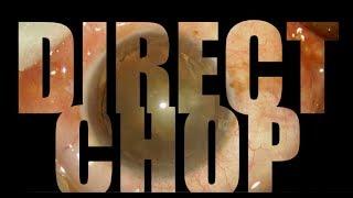 Direct Chop Phaco For Beginners : (Unedited Video)