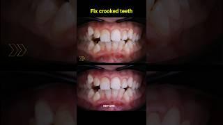 Fix crooked teeth, best braces #braces #orthodontist #dentist