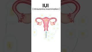 IUI Process |  Pravi Test Tube Baby Centre Kanpur