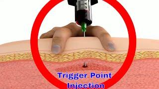 Trigger Point Injection and Diagnostic Techniques for Pain Relief 트리거 포인트 주사와 통증 유발점 검사법