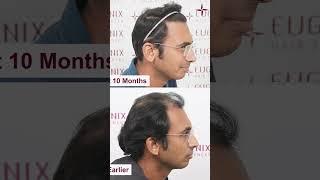 Hair Transplant in Delhi | Best Results and Cost of Hair Transplant in Delhi