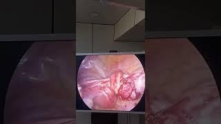 TB , FIBROID LAPAROSCOPIC MYOMECTOMY