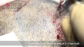 Harleys Clinic - How Follicular Unit Extraction (FUE) Procedure is Performed