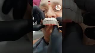 Full Mouth Dental Implants | Smile Transformation | Best Dental Hospital In INDIA | Eledent Hospital