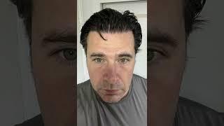 Hair Transplant Result | Hair Transplant Timelapse | Hair Transplan Before and After 5000 grafts