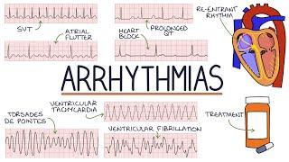 Understanding Arrhythmias