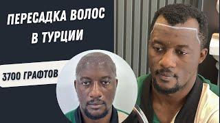 Пересадка волос в Турции | Пересадка Волос процесс 3700 графтов #пересадкаволос