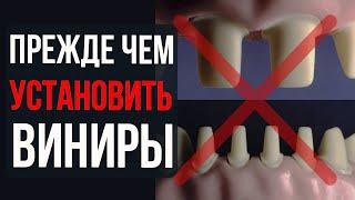 Виниры Всё, что нужно знать – виды, цена, установка и уход!