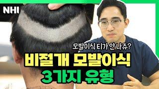 비절개 모발이식 3가지 삭발 유형(무삭발,부분삭발,삭발)ㅣ뉴헤어