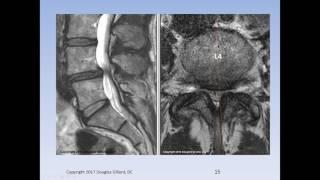 Lumbar Spinal Stenosis, Cauda Equina Syndrome, Sciatica, & Disc Herniation: An Advanced Lecture.