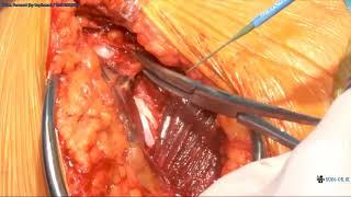 Total shoulder Arthroplasty آموزش تعویض مفصل شانه با دوبله فارسی