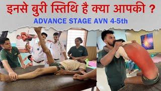 Ph.8171760203, 4-5th ADVANCE STAGE AVN - आयुर्वेद अग्निकर्म | Dr.Amit Bharti Dehradun