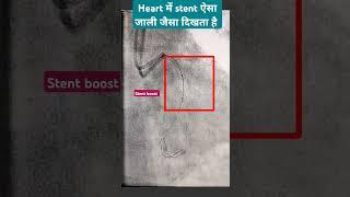 Heart Stent l Angiography l #echo #ecg #heartattack #shorts