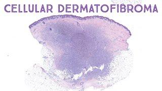 Cellular dermatofibroma (dermpath pathology dermatology)