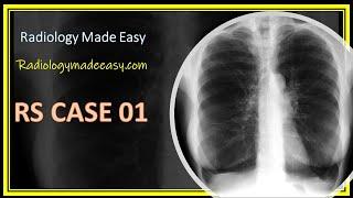 FRCR Radiology RS case 01: 60 yrs old patient presented with chronic SOB