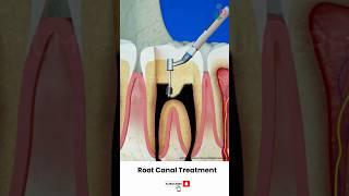 Root Canal Treatment Procedure ↪ 3D Medical Animation #Shorts #RootCanal #Tooth