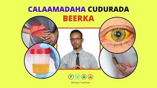 Cudurada Beerka | 10 Calaamadood Oo Lagu Garto