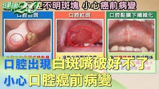 口腔出現白斑、嘴破好不了 小心口腔癌前病變 健康2.0