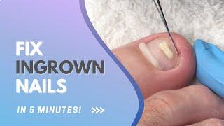 Ingrown Toenail Treatment Tutorial - How to Fix Ingrowns with ONYFIX