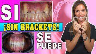 ‍️¿Quieres 𝗘𝗡𝗗𝗘𝗥𝗘𝗭𝗔𝗥 los dientes 𝗦𝗜𝗡 𝗕𝗥𝗔𝗖𝗞𝗘𝗧𝗦? Como Funcionan los 𝗔𝗟𝗜𝗡𝗘𝗔𝗗𝗢𝗥𝗘𝗦 𝗜𝗡𝗩𝗜𝗦𝗜𝗕𝗟𝗘𝗦