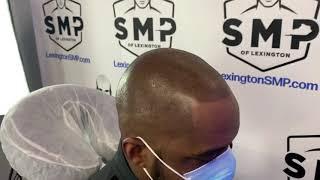 Scalp Micropigmentation (SMP) to the rescue!