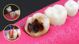 Amazing Root Canal Treatment And Onlay Restoration Of Carious Tooth In 4K.