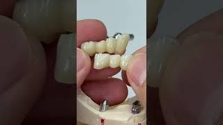 Two different implants prosthetic!
