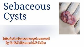 Infected sebaceous cyst removal by #Dr S.K Sharma M.S Ortho #Surya Orthopedic