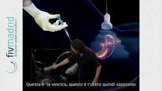 Trasferimento degli embrioni in utero (embryo transfer)