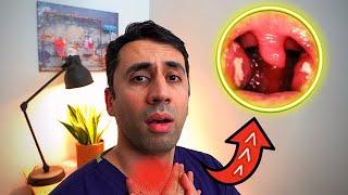 What Causes a Sore Throat? HOME Remedies and Cures for Fast TREATMENT| Doctor Explains