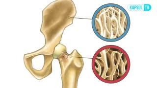 Osteopeni ve Osteoporoz Arasında Ne Fark Vardır?