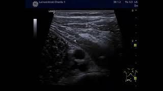 Sonographie einer Appendizitis