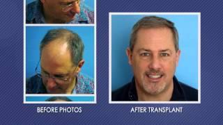 Hair Transplant Patient Testimonial - Dr. Scot Boden - HairTransplantCT.com