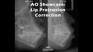 Alexandria Orthodontics Showcase: Incisor protrusion correction with extractions