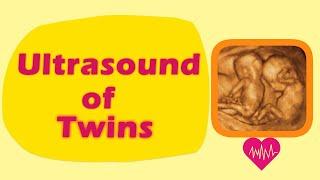 Sonography of Twins