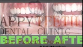 Happy Teeth | Paediatric Dentist In Ahmedabad